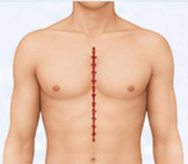 Cirurgia Convencional