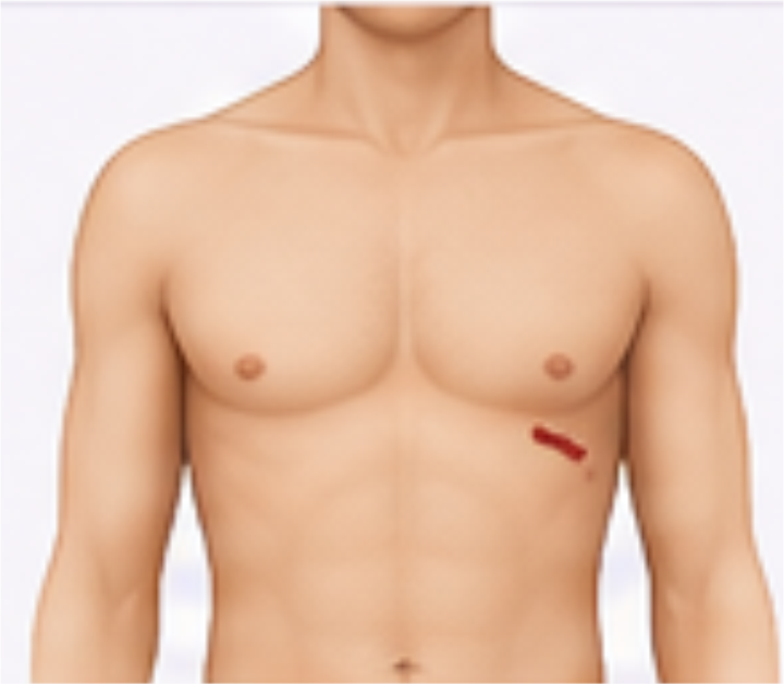 Cirurgia MICS